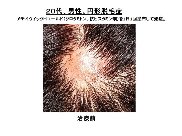 円形脱毛症　病院